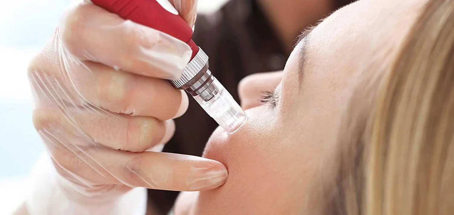 Microneedling von Nataschas Beautypalast