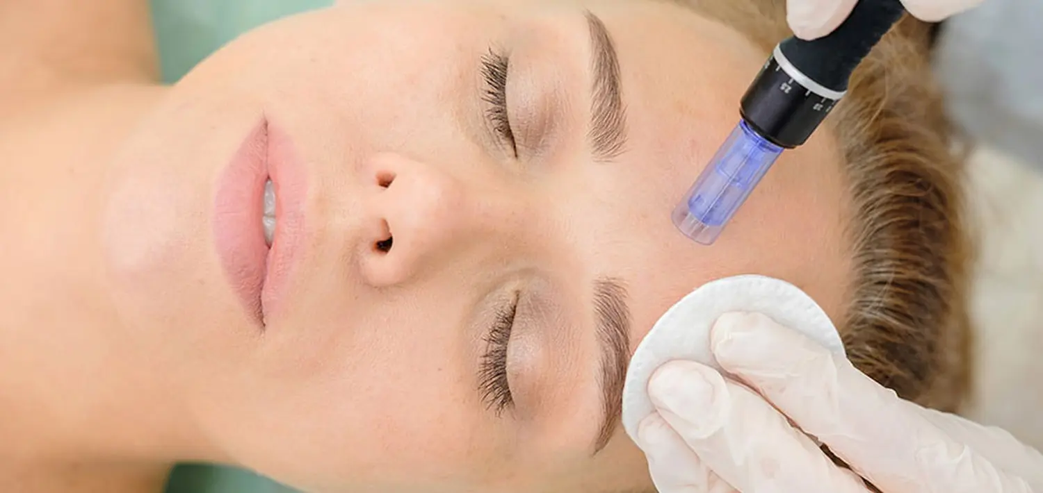 Microneedling von Nataschas Beautypalast