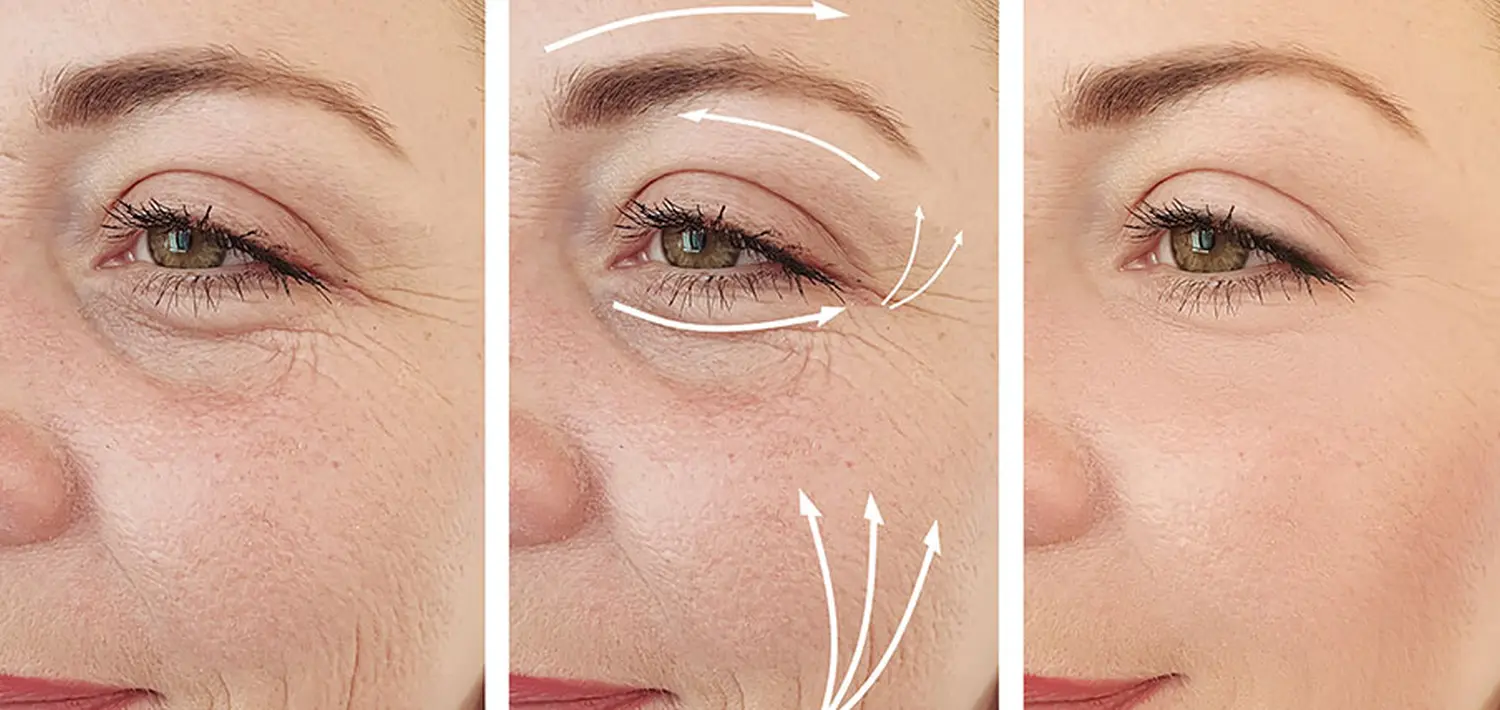 Kollagenfadenlifting von Nataschas Beautypalast