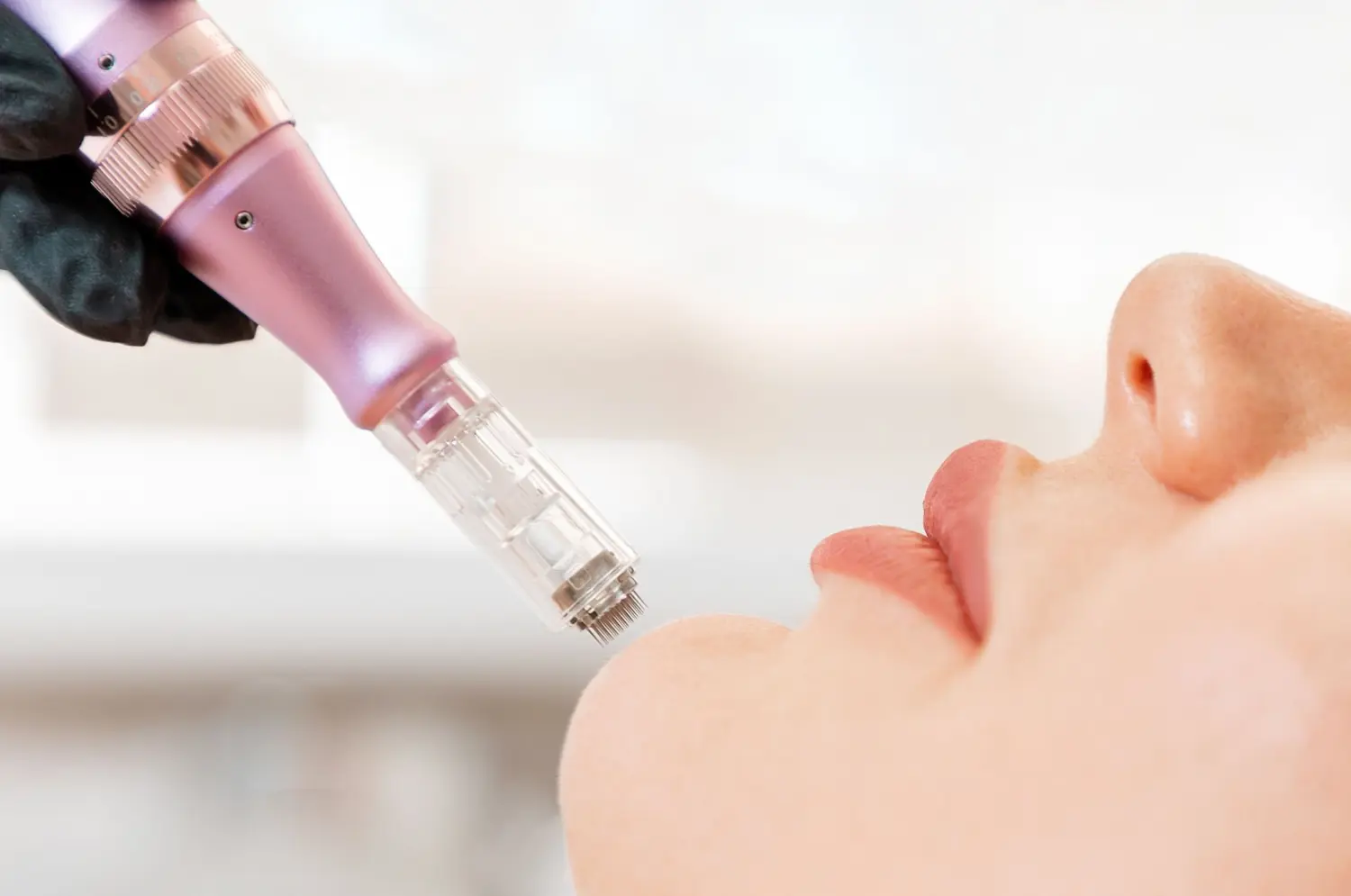 Microneedling von Nataschas Beautypalast